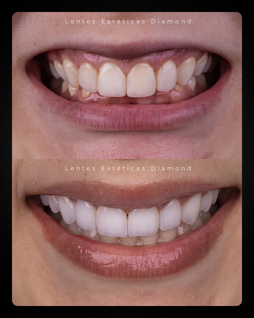 Diamond_post_feed_antes_depois-_FABIANA---Bruna-Dantas