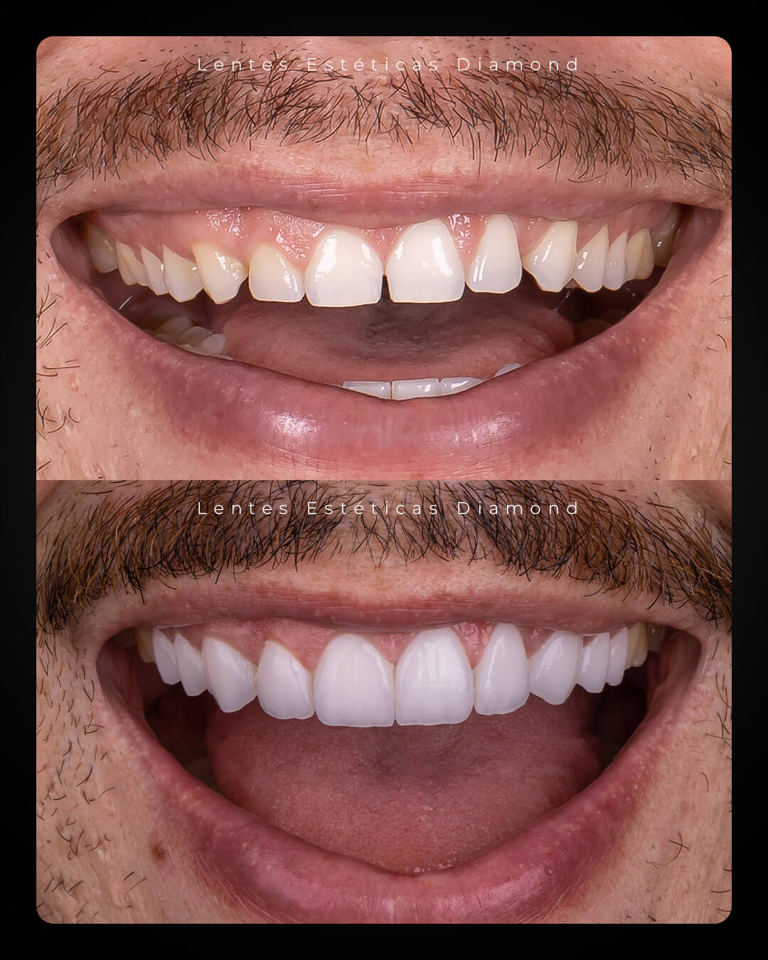 Diamond_post_feed_antes_depois-_FABIANA---Bruno-Sestito