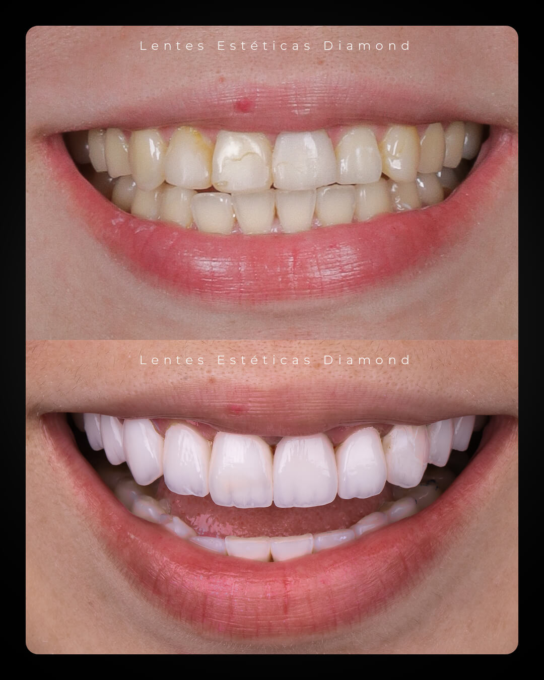 Diamond_post_feed_antes_depois-_FABIANA---Camila-Ogusko