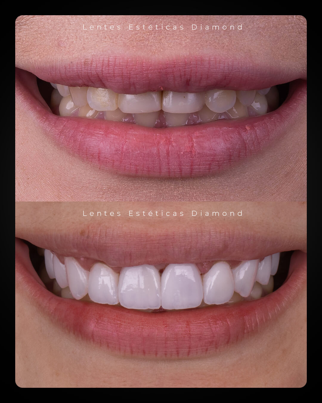 Diamond_post_feed_antes_depois-_FABIANA---Ester-Mendes