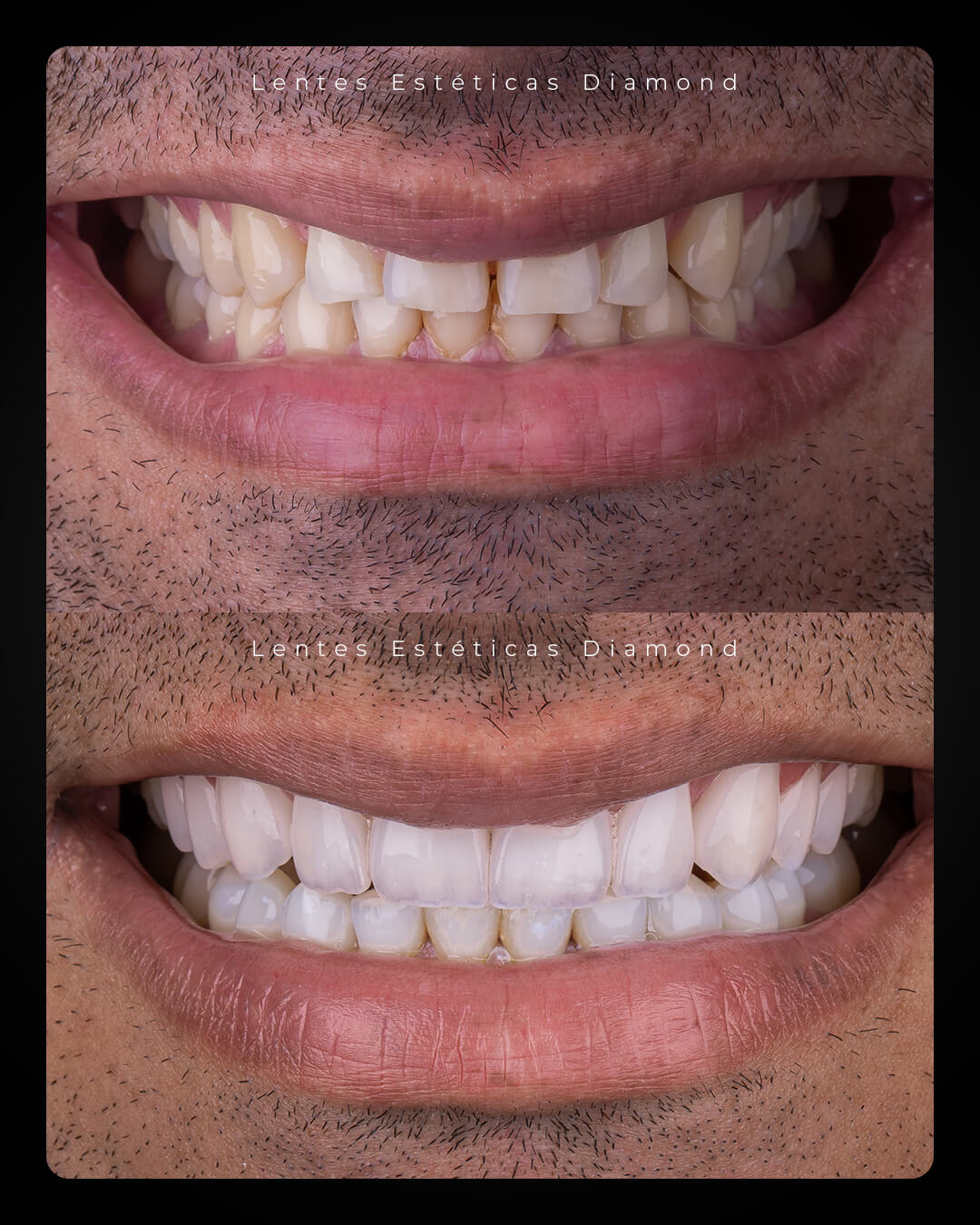 Diamond_post_feed_antes_depois-_FABIANA---Francisco-Henrique