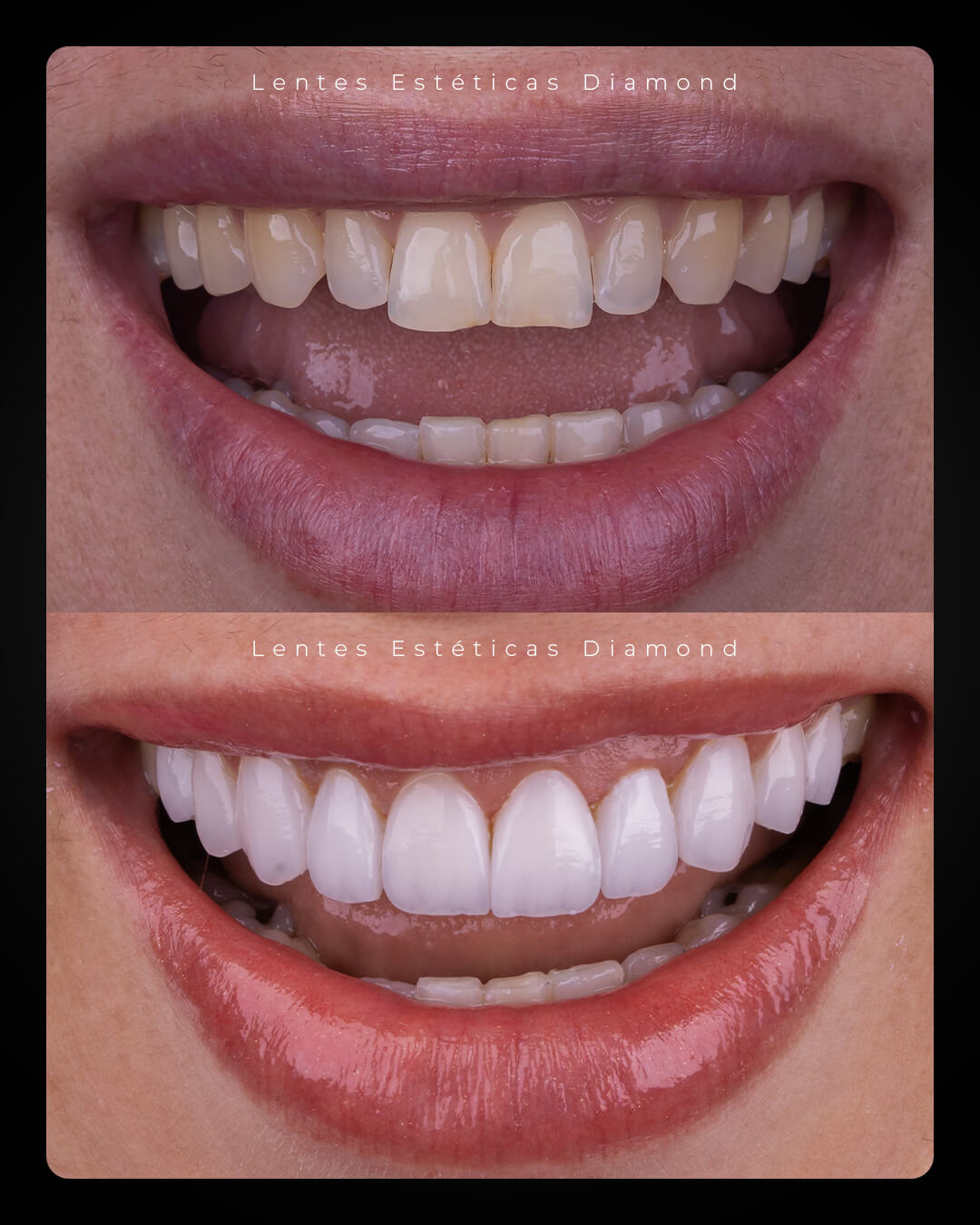 Diamond_post_feed_antes_depois-_FABIANA---Janaina-Gusson