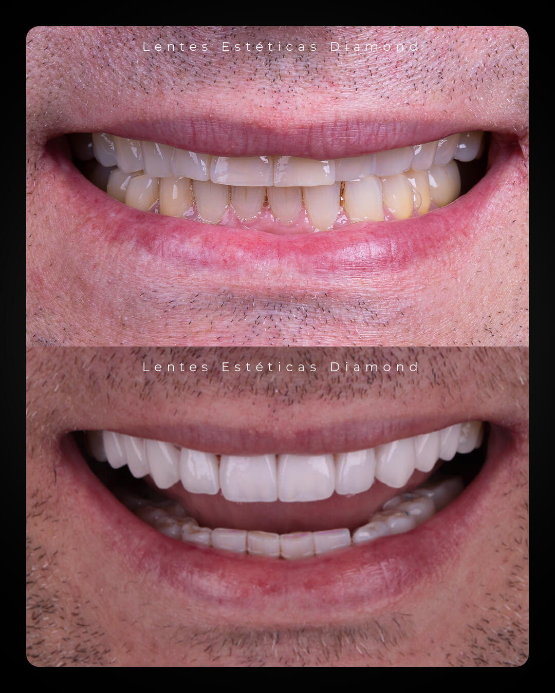 Diamond_post_feed_antes_depois-_FABIANA---José-Eduardo