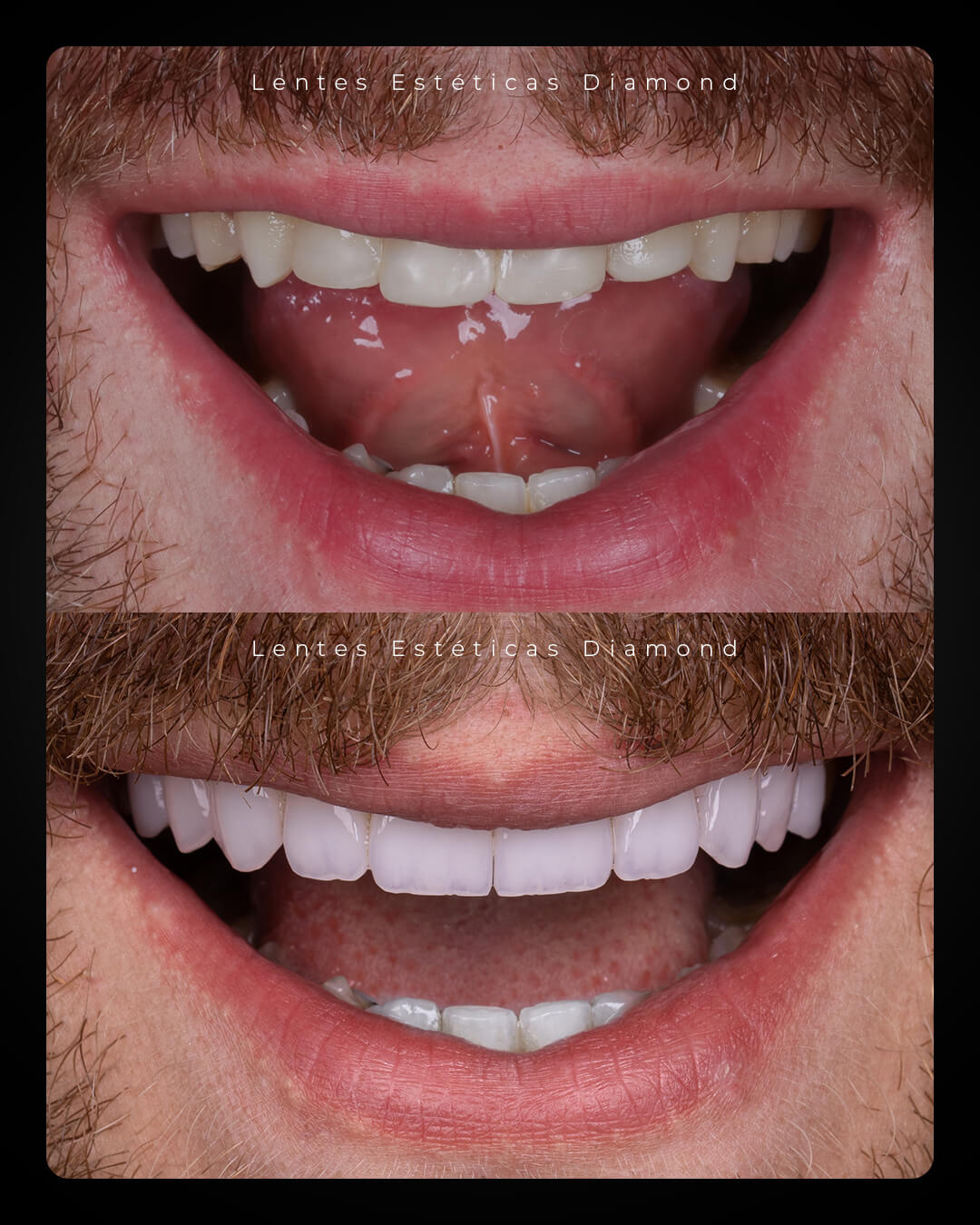 Diamond_post_feed_antes_depois-_FABIANA---Leonardo-Nascimento