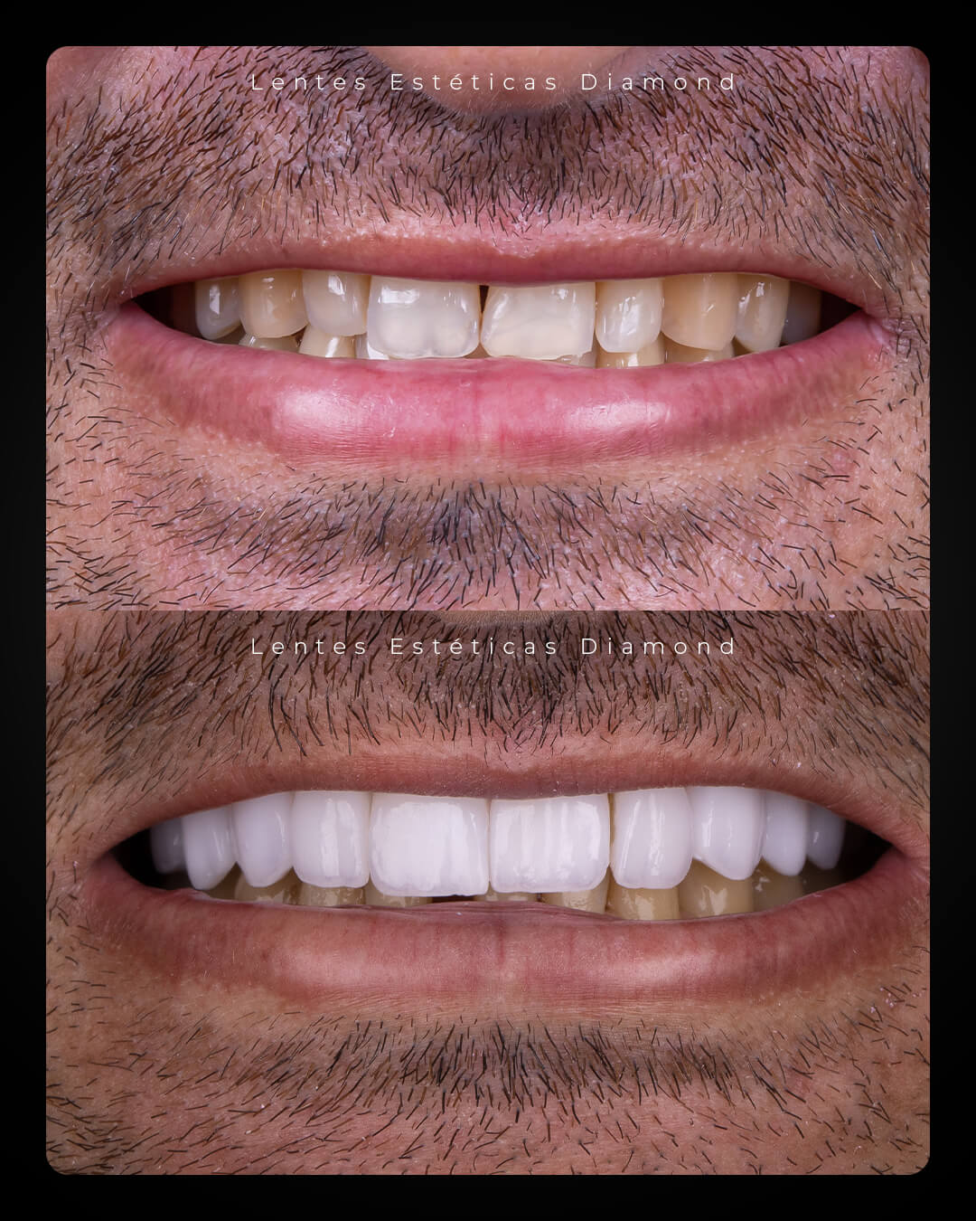 Diamond_post_feed_antes_depois-_FABIANA---Watilla-Souza